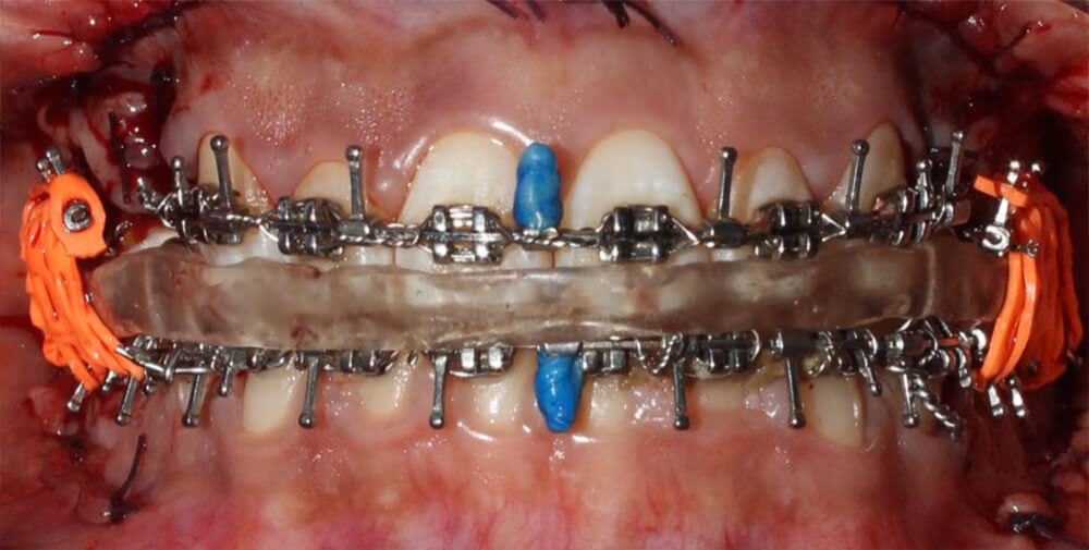 Fig. 12 Intraoral post-quirúrgica