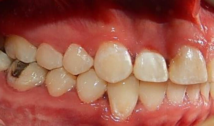 Fig. 15 Intraoral lateral derecha