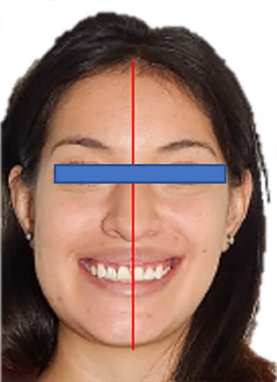 Fig. 18 Corrección de asimetría facial