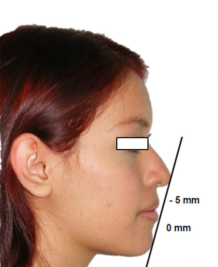 Fig. 2 Extraoral de perfil