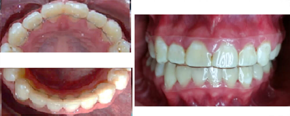 Fig 20. termoformado superior e inferior y de frente.