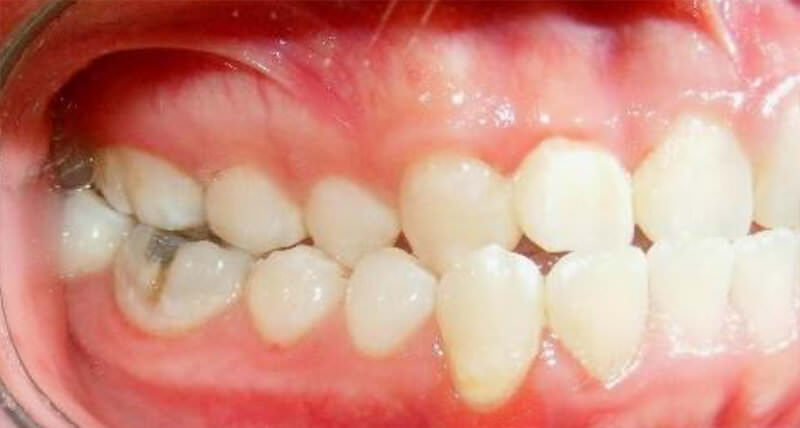 Fig. 4 Intraoral derecha