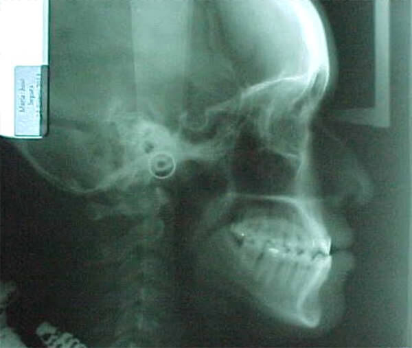 Fig. 6 Radiografía lateral de cráneo