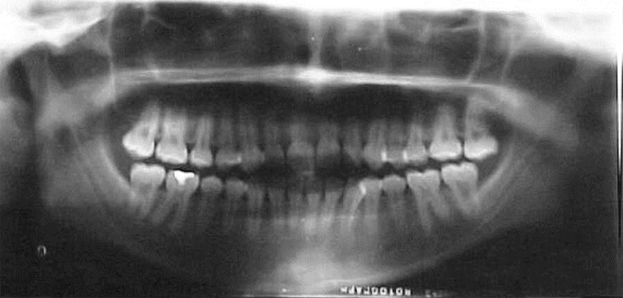 Fig. 7 Radiografía panorámica inicio