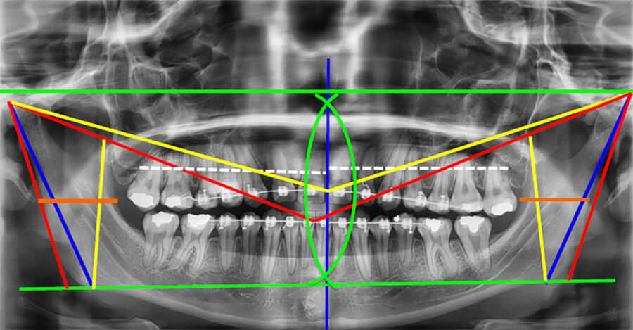 Fig. 8 Trazos análisis de Levandoski