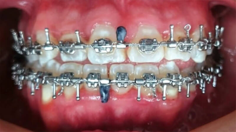 Fig. 9 Intraoral de frente con vástagos quirúrgicos