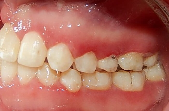 Fig. 14 Lateral izquierdo