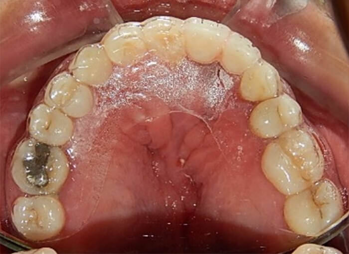 Fig. 15 Retenedor superior