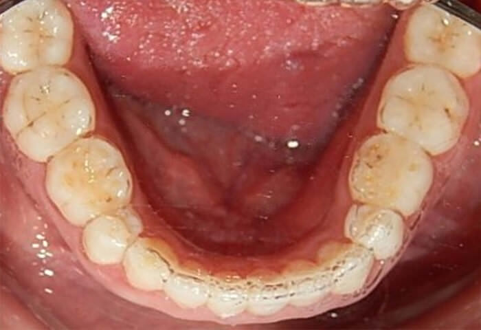 Fig. 16 Retenedor Inferior