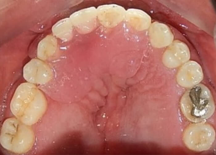 Fig. 17 Superiores con su Valplast