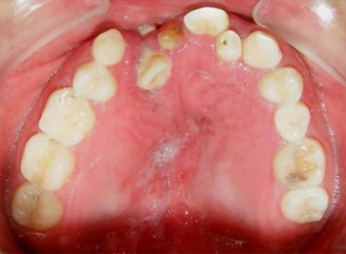 Fig. 6 arcada superior fisura palatina