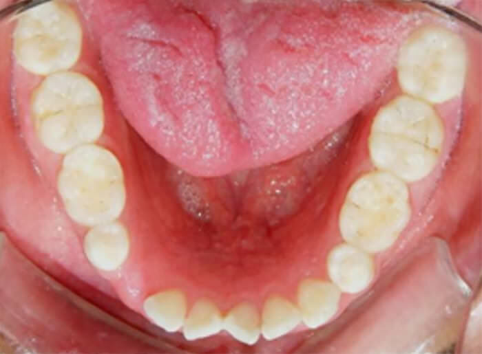 Fig. 7 arcada mandibular