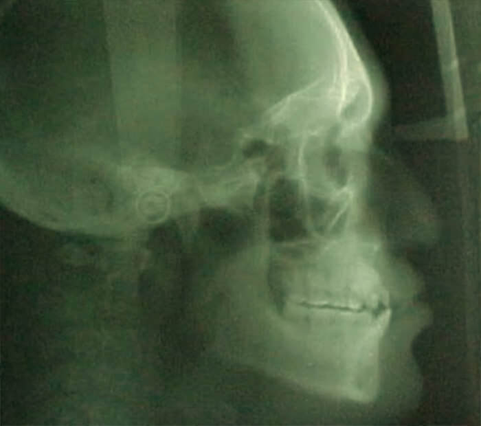 Fig. 8 Radiografía lateral de cráneo de inicio