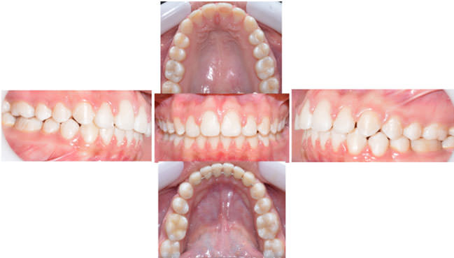 Fig. 4 fotografias intraorales finales. 