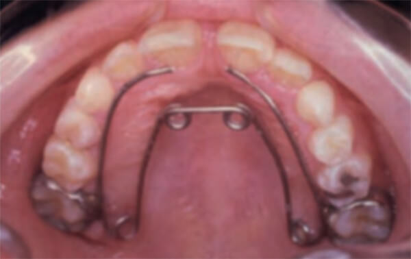 Figura 3 Quad Helix.  Aparato de ortodoncia metálico fijo.