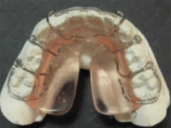 Figura 4 Placa acrilica inferior elevadora de lengua. Es una placa removible de uso parcial.