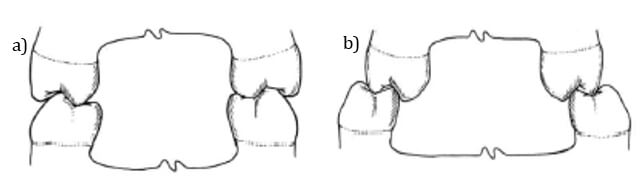 Figura 1: a) oclusión normal transversalmente con el resalte de los dientes superiores sobre los inferiores. b) Mordida cruzada posterior bilateral (Extraída de Padilla et al.,2009)