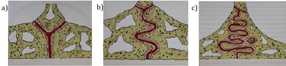 Figura 2: La sutura palatina se hace más tortuosa e imbricada con la edad a) Durante la lactancia es casi rectilínea b) En la infancia (dentición mixta precoz) c) Comienzo de la adolescencia (Extraída de Proffit et al.,2008, p.353) 