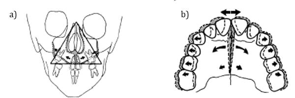 Figura 3: Efectos sobre el esqueleto de la expansión maxilar. a) patrón triangular de expansión en plano frontal, b) vista oclusal de la expansión maxilar. La mayor apertura a nivel anterior genera cambios a nivel de la cavidad nasal. (Tomada de Bell, 1982)