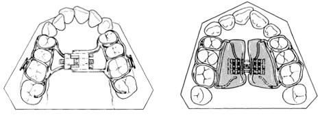 Figura 4: a) Aparato expansor tipo Hyrax y tornillo central b) Aparato expansor tipo Haas con tornillo central y base acrílica