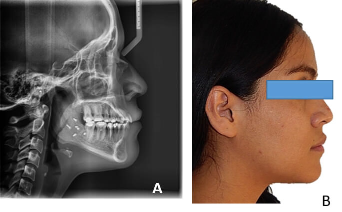 Fig.10 Rx. lateral de cráneo A, el  perfil  final B, laterales en oclusión derecha C,  izquierda  D