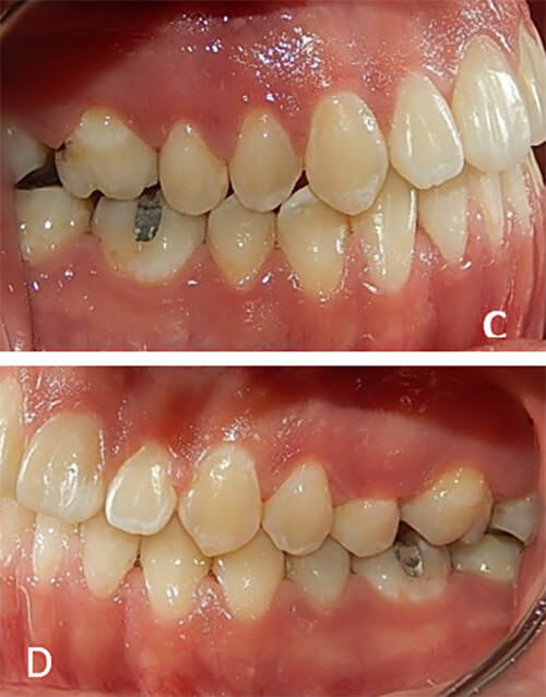 Fig.10 Rx. lateral de cráneo A, el  perfil  final B, laterales en oclusión derecha C,  izquierda  D