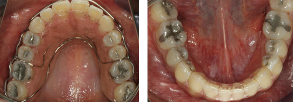 Fig. 11 A. final del tratamiento con los retenedores  superior  e   inferior