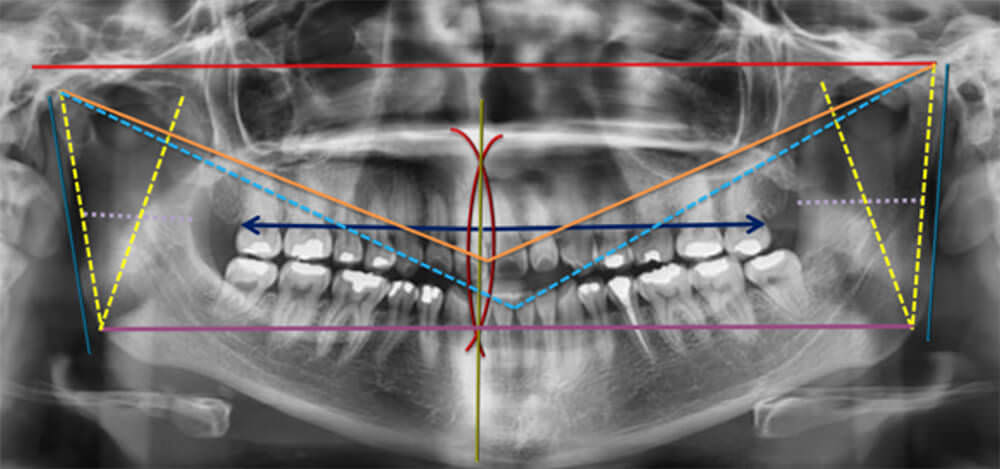 Fig. 2 Rx panorámica inicio