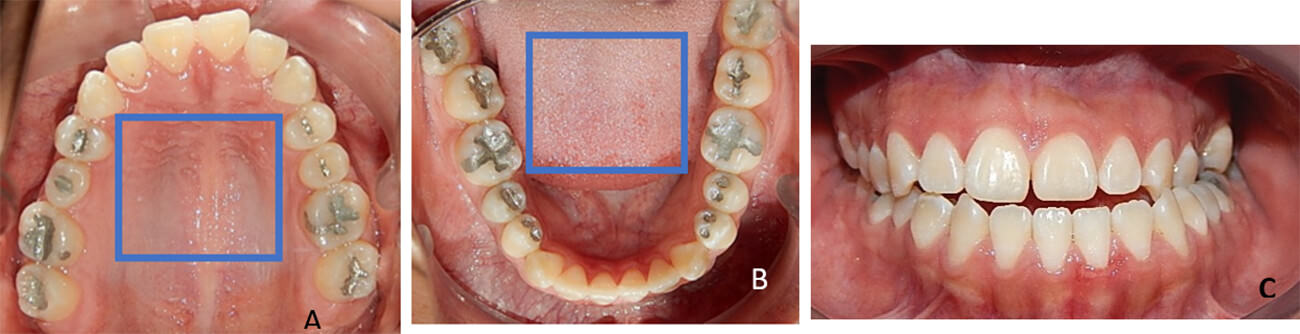 Fig. 5 Oclusal superior A,  inferior B, frente C