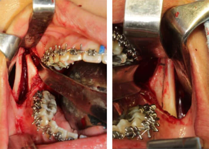 Fig. 6 Osteotomía sagital derecha e izquierdo