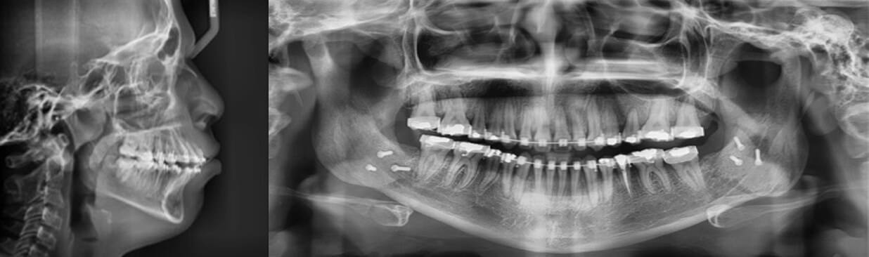 Fig.7 Radiografias lateral de cráneo y panorámica 