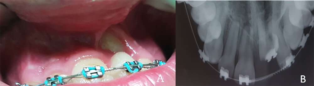 Imagen 1 A. Evaluación clínica del diente instruido y mantenimiento del espacio del central izquierdo superior con tratamiento ortodóncico. B. Evaluación radiográfica del diente instruido.