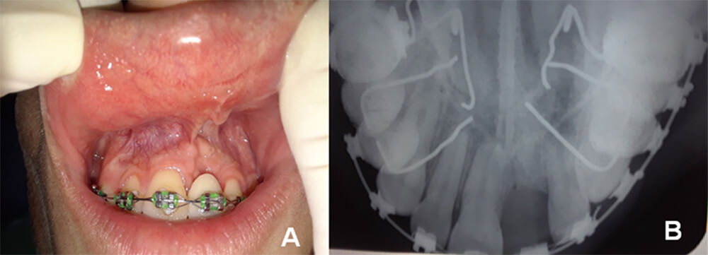 Imagen 3 A Evolución clínica a los siete meses donde se observa una cicatrización de la encía por vestivular  y se observa radiograficamente formación ósea. 
