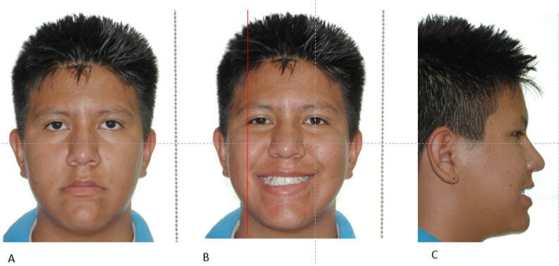 Figura 1 A) Fotografía de sonrisa B) Fotografía frontal C) Fotografía de perfil