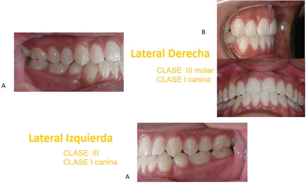 Figura 9. A) Fotografías laterales finales B) Fotografías del overjet y overbite