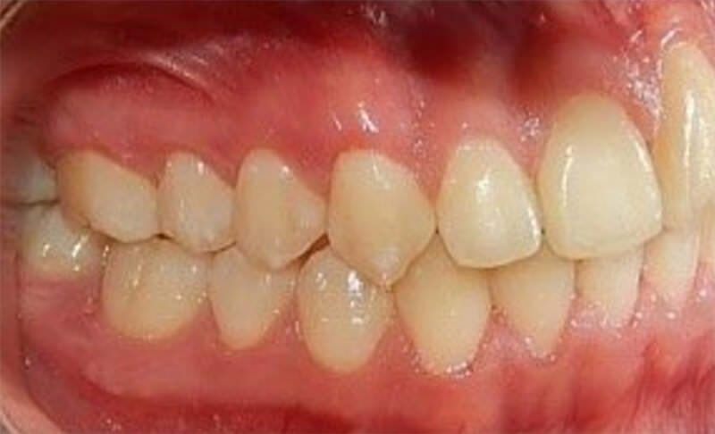 Fig.16 intraoral derecha