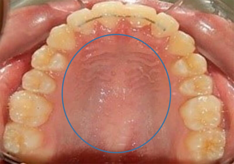 Fig.19 oclusal superior