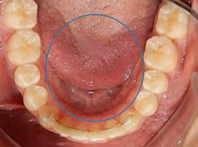 Fig.20 oclusal inferior