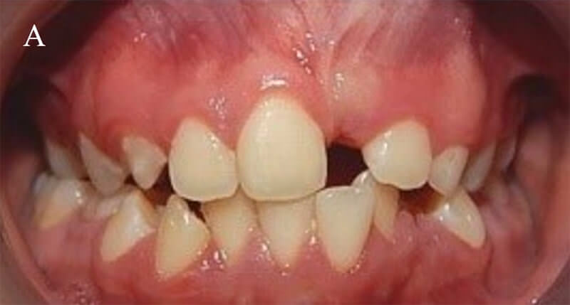 Fig.22 comparaciones inicio (A)