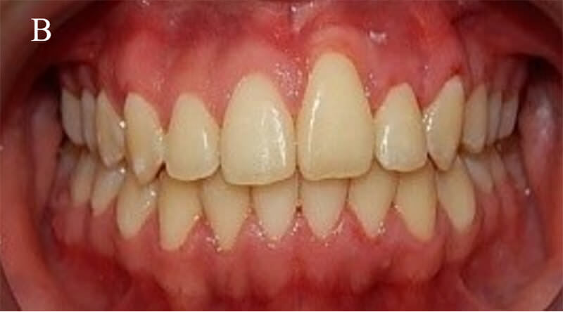 Fig.22 final (B) fotografía intraoral de frente