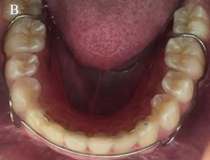 Fig.23 retenedor inferior (B)