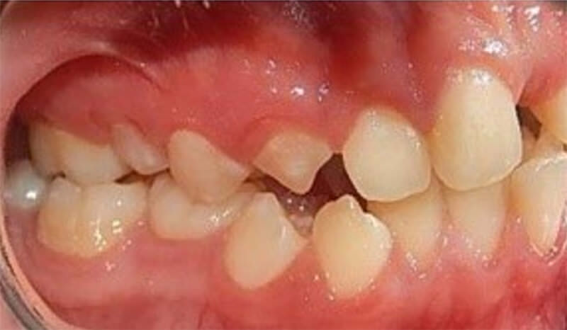 Fig. 3 Intraoral derecha