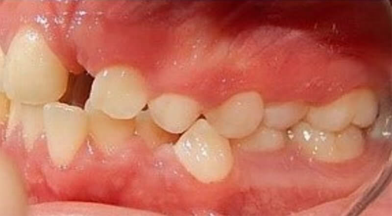 Fig. 4 Intraoral izquierda