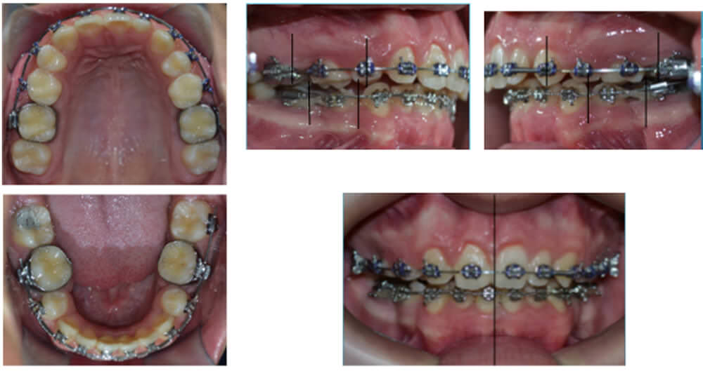 Fig. 6 Análisis Intraoral de estudios intermedios