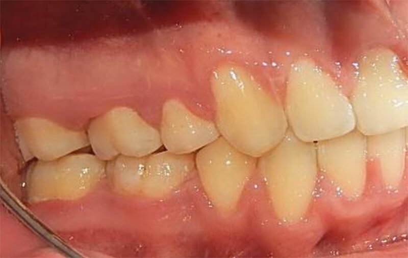 Fig. 9 Lateral derecha la clase I molar y canina.
