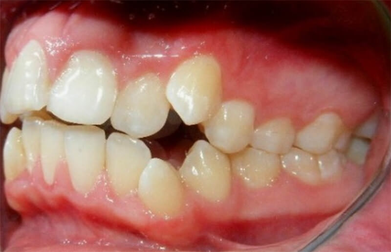 Fig. 2B Intraoral izquierda