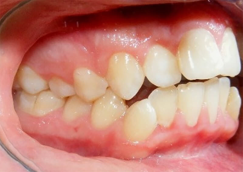 Fig. 2A Intraoral derecha