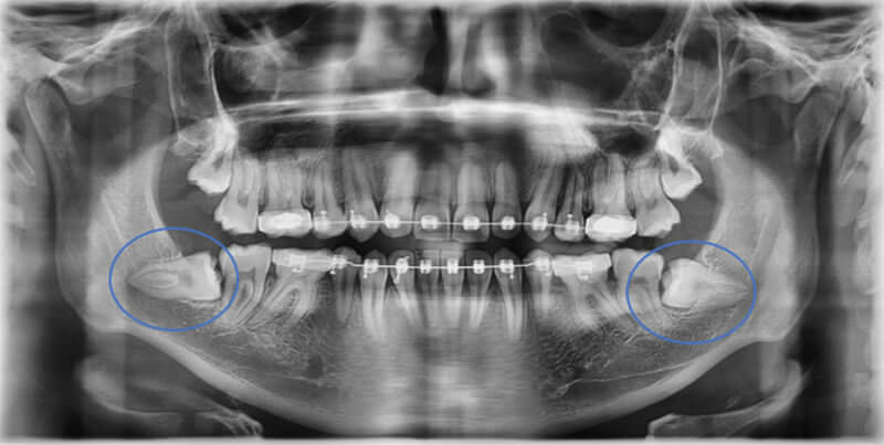 Fig. 5 Radiografía panorámica posición de los terceros molares inferiores.