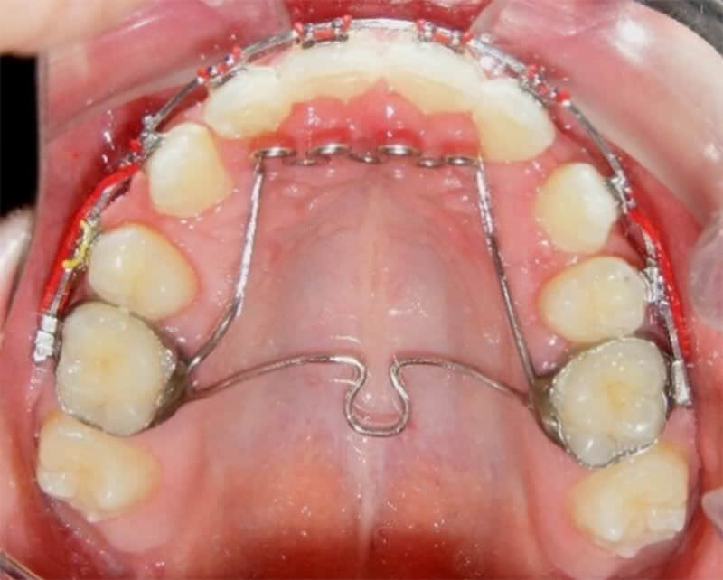 Fig. 4 Vista oclusal con ATP modificado con trampa lingual