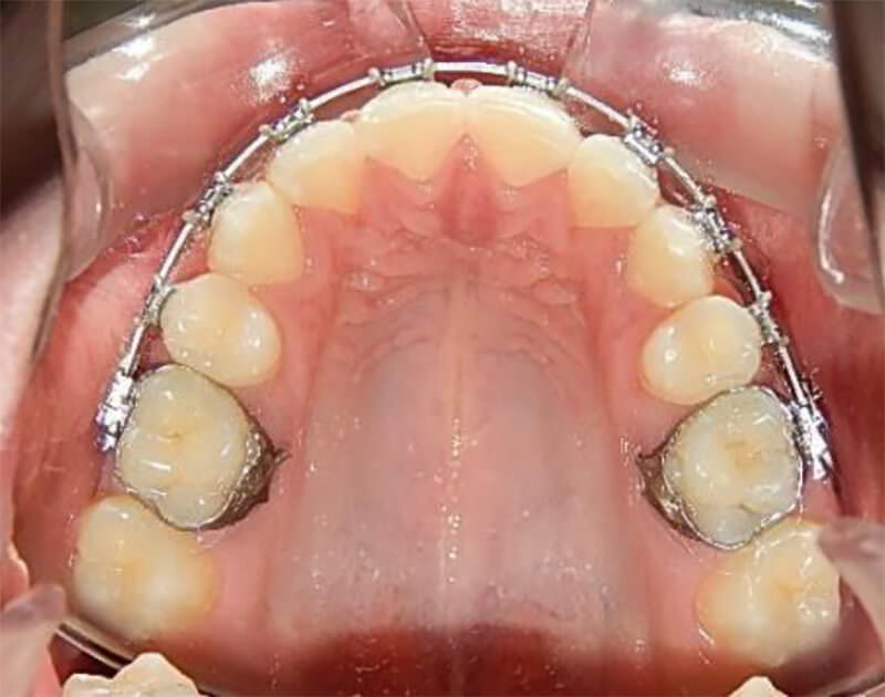 Fig. 4 vista oclusal con ATP modificado con trampa lingual